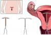 Types of intrauterine sirals Golden spiral from pregnancy